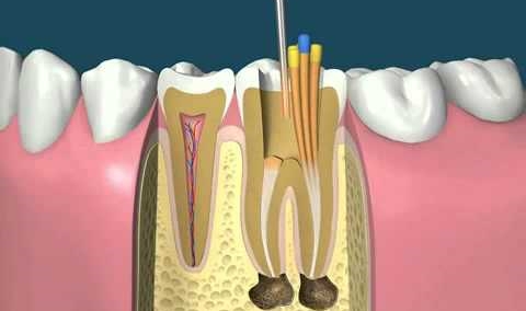 Endodonzia 2