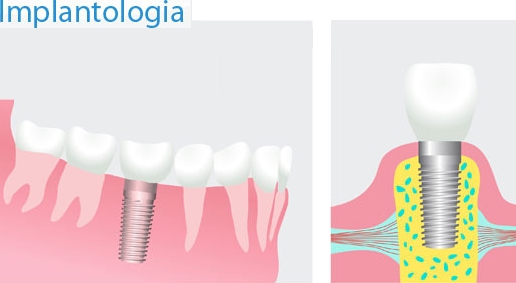 Implantologia 2